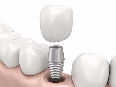 在承德哪家口腔醫(yī)院口腔種植齒好一點，惟德口腔醫(yī)院值得您的選擇